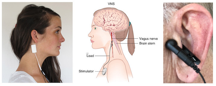 Placement of vagus nerve stimulation device. As illustrated in the