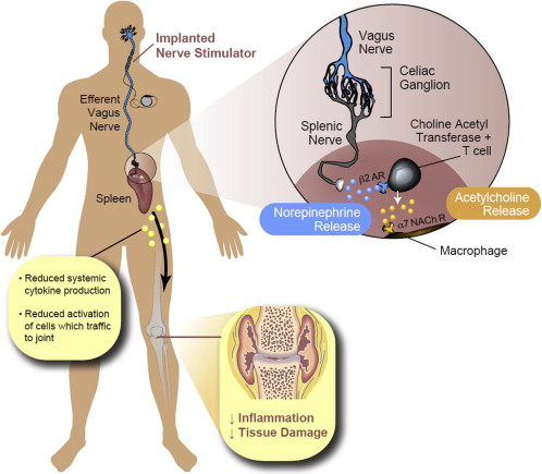 Vagus Nerve Stimulation and Treatment for Rheumatoid Arthritis